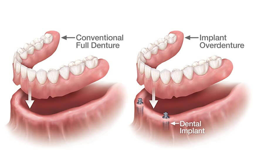 Dental Implants vs. Dentures: Which is the Better Choice?