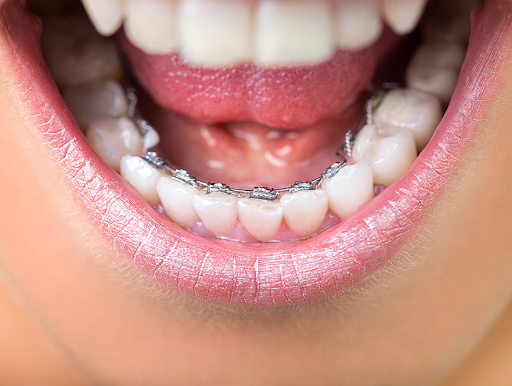 Lingual Braces