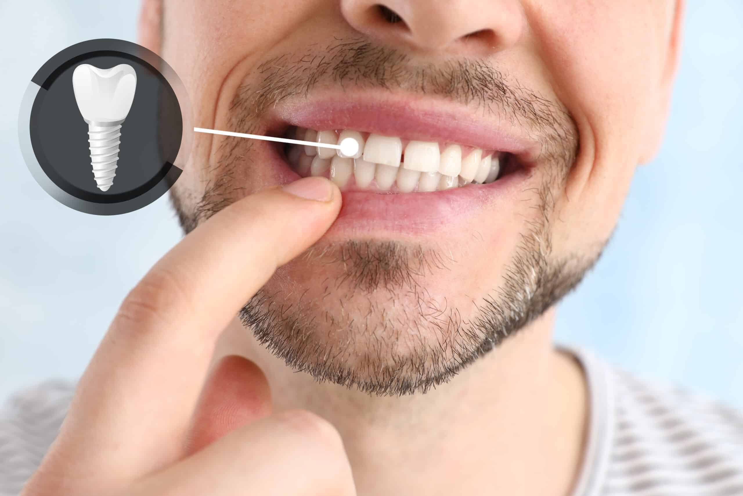 worrying about dental implant pain?