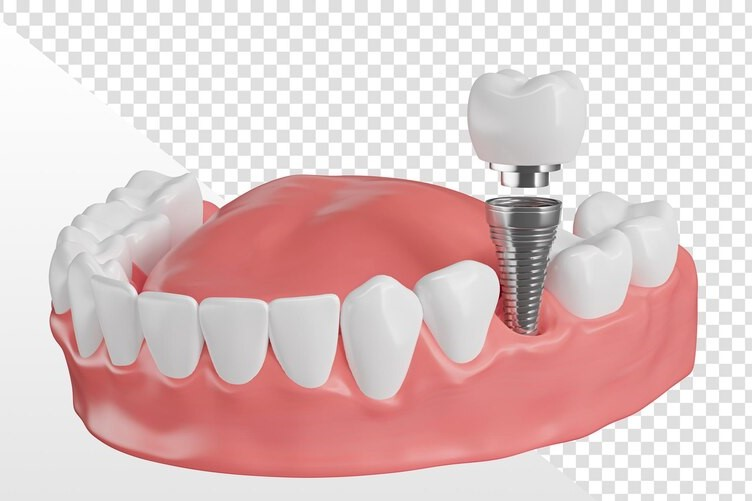 Dental Implants in Dubai: The Ultimate Solution for Missing Teeth